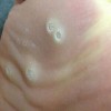 长鸡眼的原因有哪些