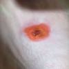 解读导致鸡眼的原因