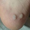 鸡眼的病因