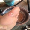 鸡眼有什么症状