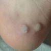 脚上长鸡眼症状有哪些