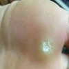 脚上鸡眼的症状有哪些