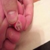 鸡眼长什么样子