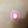 激光治疗鸡眼怎么样呢