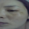 关于雀斑的相关介绍