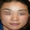 介绍几种去雀斑的方法