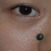 色素痣是由什么引起的呢