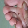 了解色素痣是什么吧