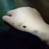 手术去除色素痣可行吗