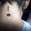 激光去除黑色素痣怎么样呢