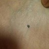 鼻子上有色素痣