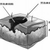 色素痣怎么治疗
