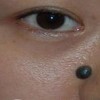几种医治色素痣的相关办法