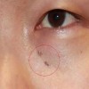 怎样消除黑色素痣