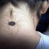 无色素痣如何淡化