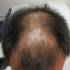 关于脱发的原因有哪些的一个介绍