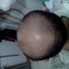 脂溢性脱发怎么治疗好