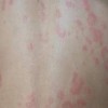 患有荨麻疹需彻底排查症状