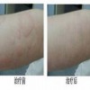 荨麻疹的有效治疗方法需做具体检查
