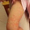 荨麻疹的典型症状有哪些
