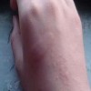 关于荨麻疹的介绍