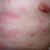 什么是色素性荨麻疹