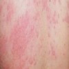荨麻疹的10类中医对症法