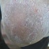 银屑病患者怎样护理皮肤