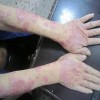 银屑病如何辨证治治疗