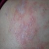 银屑病的皮疹为什么红并且伴有瘙痒