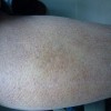 鱼鳞病有哪些危害吧