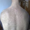 鱼鳞病的并发症是哪些