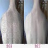 患上鱼鳞病要做哪些检查呢