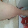 怎样操控鱼鳞病的病况