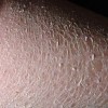 鱼鳞病有没有防治方法