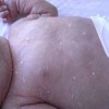 鱼鳞病都有哪些发病原因