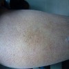 女性鱼鳞病病因是什么