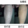 为什么鱼鳞病冬重夏轻