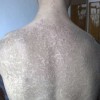 鱼鳞病与身体内部血液的关系