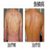 什么是鱼鳞病的主要症状
