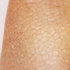 重视鱼鳞病的危害科学进行治疗
