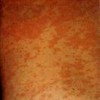 原发性皮肤结核综合征是什么
