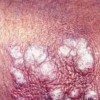 原发性皮肤结核综合征容易与哪些疾病混淆