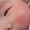 婴儿急性荨麻疹和风疹有关系吗