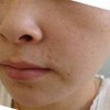 化脓性汗腺炎的护理方法