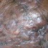 化脓性汗腺炎的预防方法