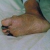 多发性硬化症如何护理措施
