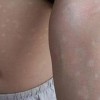 花斑癣能否治愈