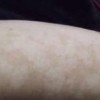 如何快速去除花斑癣