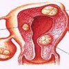 女性外阴黏膜白斑的预防
